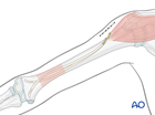 Management of simple transverse pediatric humeral shaft fracture with Antegrade elastic nailing (lateral insertion)