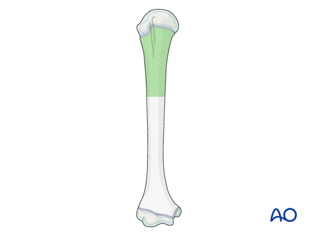 Different nail insertion techniques for stabilizing fractures in various parts of the humerus.