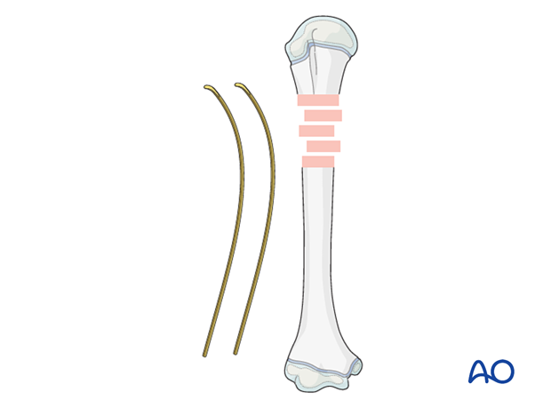 Precontouring the nail