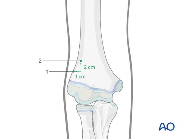 Entry points for nail insertion in the humerus, with caution to avoid fractures if holes are too close.