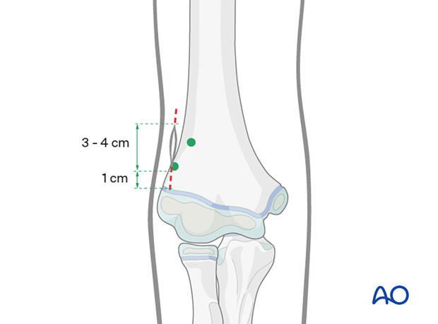 Incision starts 1 cm above the lateral epicondyle and extends 3-4 cm up the lateral humerus.