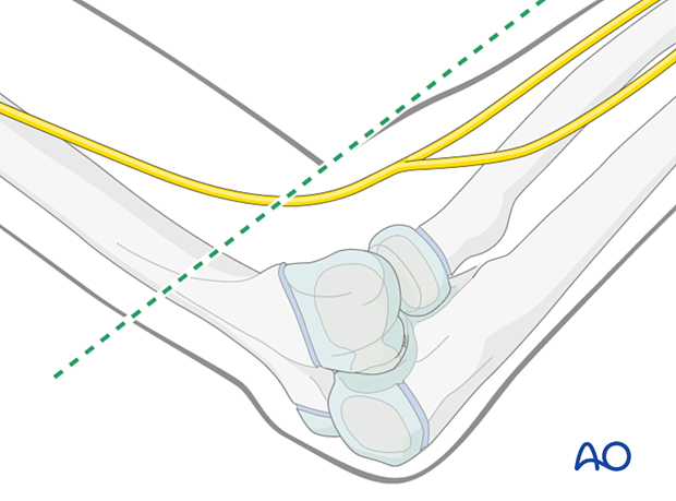 To avoid radial nerve injury, place lateral entry point below anterior forearm level with elbow at 90°.