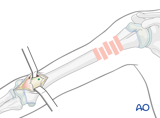Bluntly dissect subcutaneous tissue and fascia to expose the lateral supracondylar ridge, avoiding radial nerve injury.