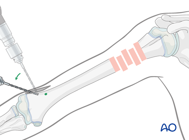 Drill perpendicular to bone, then angle to 45° to the humeral axis to prevent slipping and ease nail insertion.