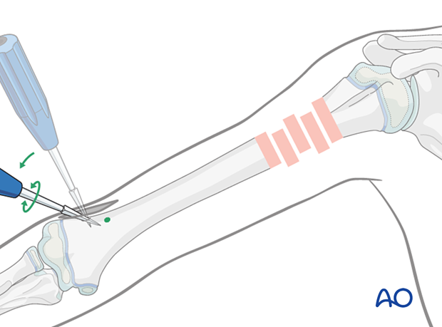 Use an awl at 90° to the cortex, then angle to 45° to enter the medullary canal. Create a second hole nearby.