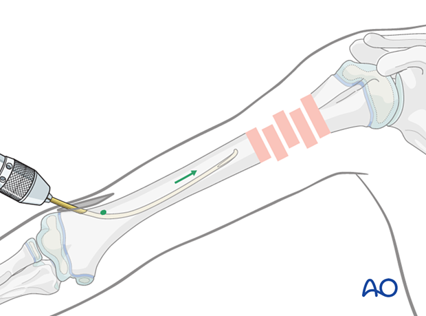 Advance the nail manually with an oscillating maneuver, orienting the tip towards the lateral cortex.