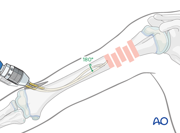 Rotate the nail 180° to avoid entanglement, verifying position with an image intensifier.