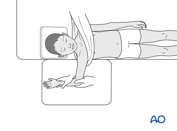 Closed reduction uses traction, abduction, and external rotation. Open reduction is needed if unsuccessful.