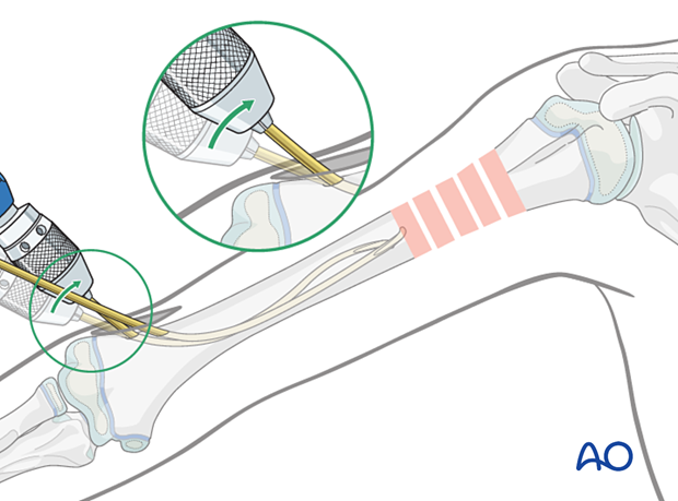 Bend the distal part of the nail upwards to create an S-shaped contour, directing the tip medially.