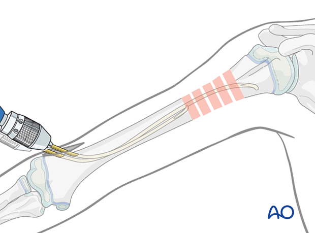 Advance the first nail across the fracture into the proximal fragment, improving reduction by rotating the nail.