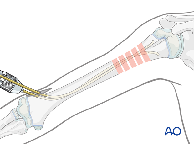 Advance the other nail across the fracture, ensuring tips are inserted divergently for stability.