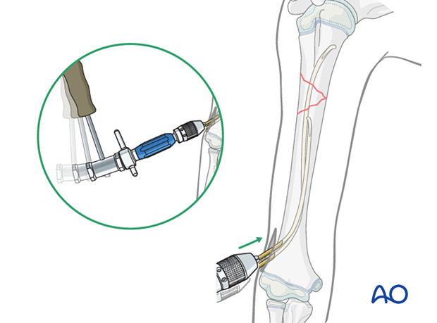 Advance nails past the fracture with gentle hammer blows, ensuring stability. End caps may be needed for comminuted fractures.