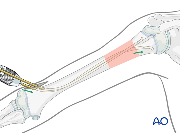 Advance nails into the proximal metaphysis, ensuring divergent tips for stability and optimal alignment.