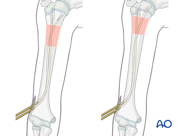 Place nail tips in the metaphysis. Advance across the physis with gentle hammer blows if needed for stability.