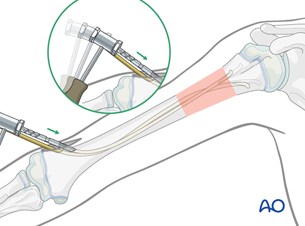 Cut nails to leave 1 cm outside the bone, or withdraw, cut, and reinsert. Secure nails with gentle hammer blows.