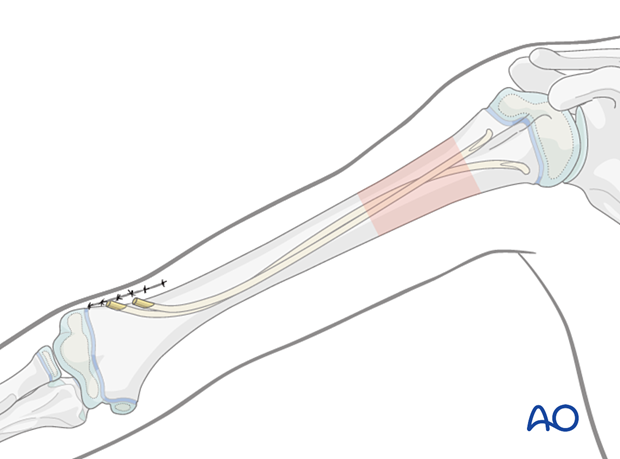 Fracture reduction and fixation with ESIN in skeletally immature patients using a monolateral technique.