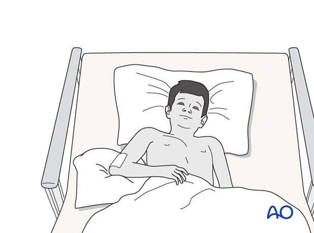 Elevate the arm on pillows to reduce swelling and pain. No additional immobilization is needed.