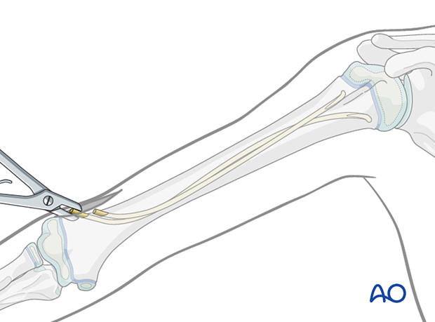 Nail ends can be palpated and seen after opening the small bursa formed around them.