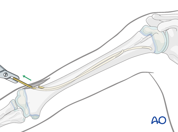Remove nails with extraction pliers or a similar clamp.