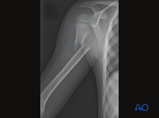 Case of a proximal third humeral shaft fracture in a 7-year-old patient. X-ray
