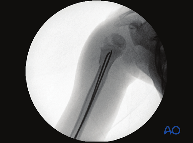 Closed reduction and retrograde lateral elastic nailing used to treat a proximal third humeral shaft fracture. X-ray