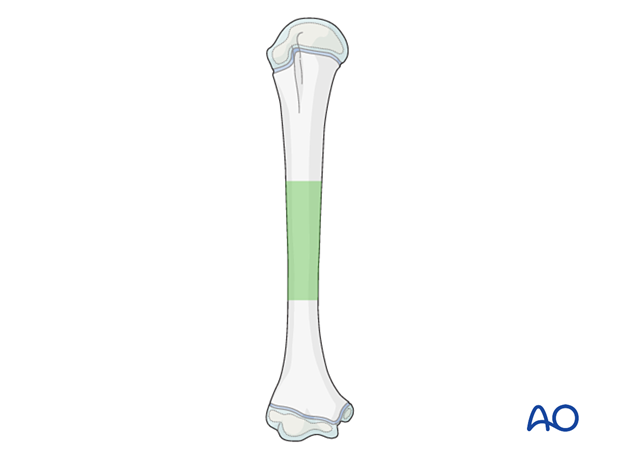 Fracture treatment: middle third with medial/lateral retrograde nails, proximal third with lateral retrograde nails, distal third with antegrade lateral nails.