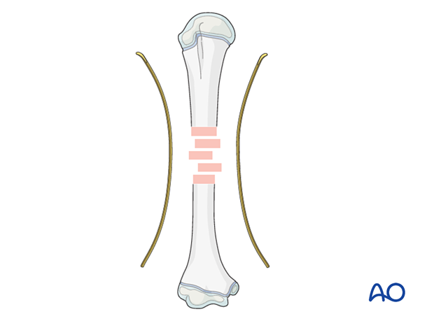 Precontouring the nail