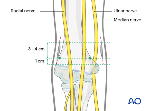 Make symmetrical medial/lateral incisions 1 cm above the epicondyles, extending 3 cm proximally. Note radial, median, and ulnar nerves.