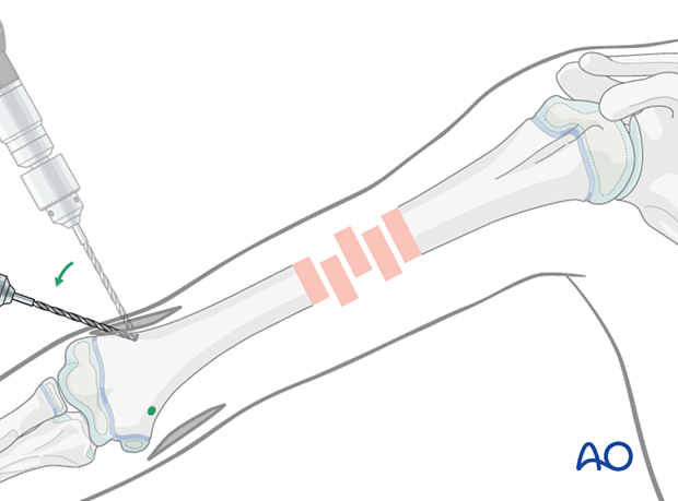 Drill bone perpendicularly, then angle to 45° to humeral axis. Note greater distance to bone on ulnar side.