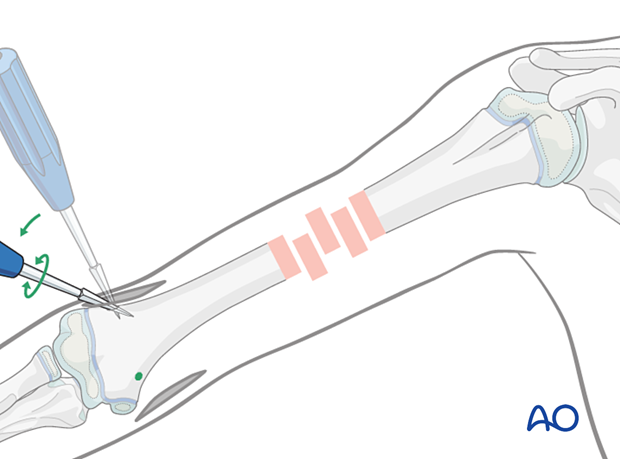 Use an awl at 90° to the cortex, then angle to 45° and advance into the medullary canal.