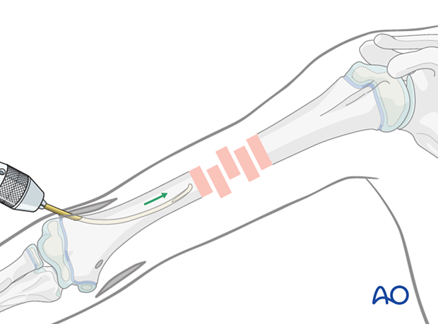 Pass the nail into the hole, advance manually to the fracture with oscillating maneuver, orientate tip laterally.