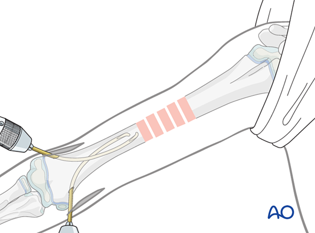 Stabilize proximal fragment, apply distal traction, manipulate nail to reduce fracture. Use anterolateral approach if needed.