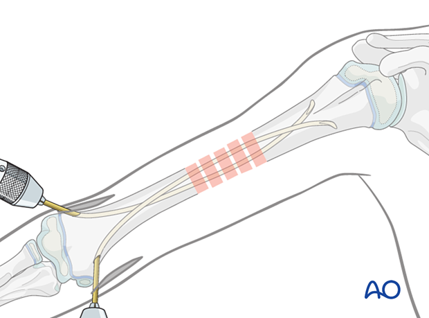 Advance the nail across the fracture, rotating the tip to improve reduction. Repeat with the other nail.