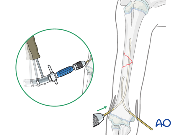 Gently hammer the first nail past the fracture into the proximal fragment. Repeat with the second nail. Use end caps if needed for stability.