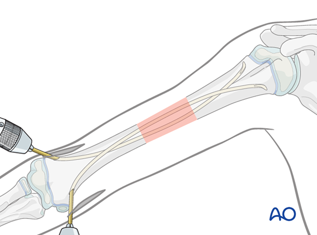 Advance nails to proximal metaphysis for good cortical contact. Rotate nails for optimal spread and alignment.