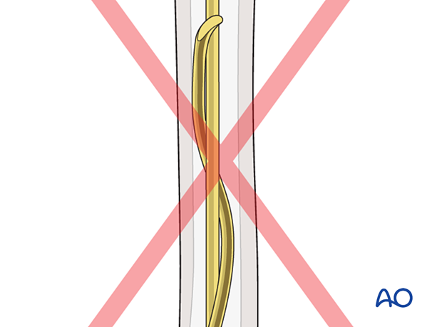 Pitfall: Avoid rotating the second nail more than 180° after inserting the first to prevent entanglement.