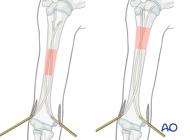 Place nail tips in the metaphysis. If needed, advance nails across the physis with gentle hammer blows.