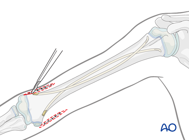 Remove nails 3-6 months post-surgery under general anesthesia. Resect scar for cosmetic closure.
