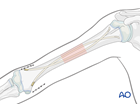 Management of simple transverse pediatric humeral shaft fracture with Retrograde elastic nailing (lateral and medial insertion)