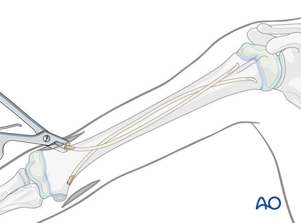 Nail ends can be palpated and seen after opening the small bursa formed around them.