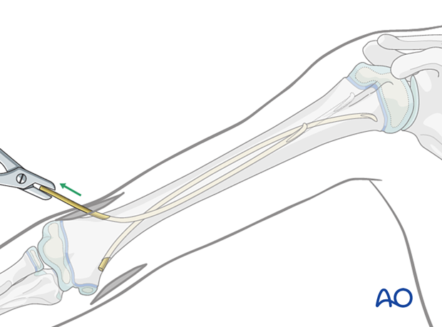 Remove nails with extraction pliers or similar clamp.