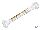 Management of simple transverse pediatric humeral shaft fracture with Open reduction and compression plating