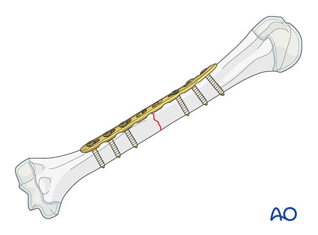 Compression plating of pediatric humeral shaft fracture, used when other techniques fail or in severe cases.