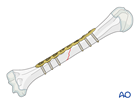 Management of simple oblique pediatric humeral shaft fracture with Open reduction and compression plating