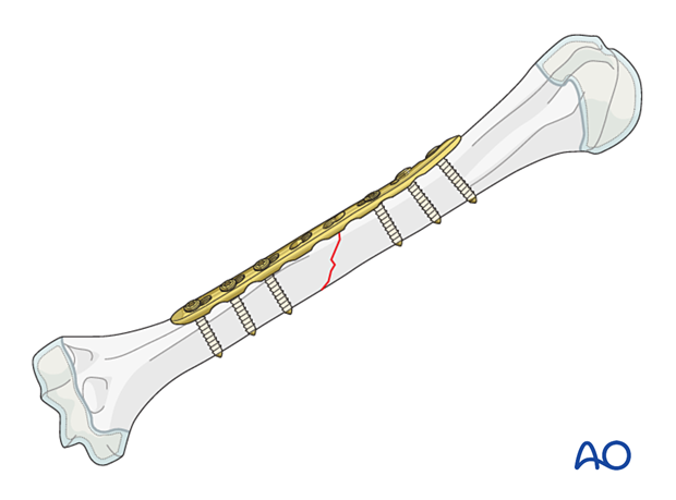 Compression plating of pediatric humeral shaft fracture, used when other techniques fail or in severe cases.