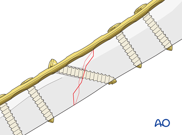 Compression plating of pediatric humeral shaft fracture, with a planned lag screw perpendicular to the fracture.