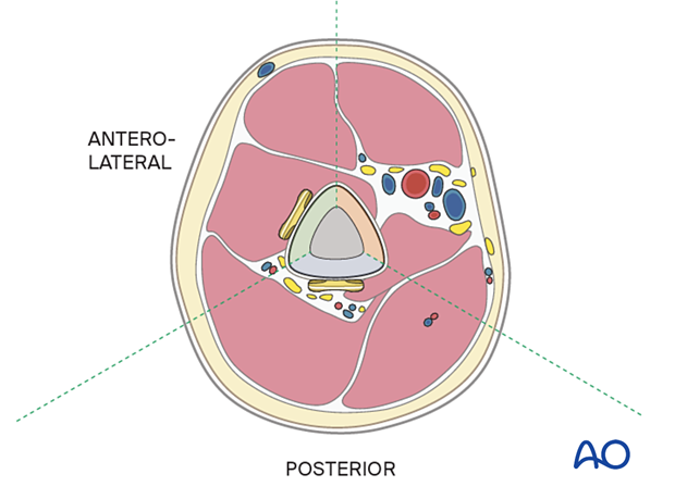 Compression plating of pediatric humeral shaft fracture, with plate position considering soft tissue and nerves.