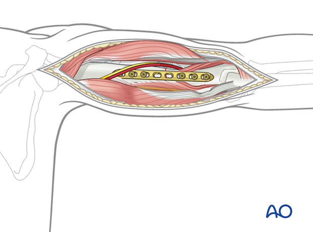 Compression plating of pediatric humeral shaft fracture, with a posterior plate preferred for mid and distal fractures.