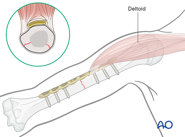 Compression plating of pediatric humeral shaft fracture, with an anterolateral plate for proximal and mid fractures.
