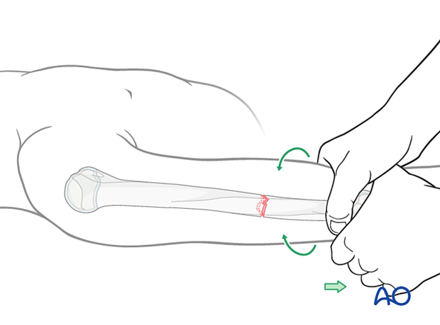 Compression plating of pediatric humeral shaft fracture, with traction, imaging, and K-wire for alignment.